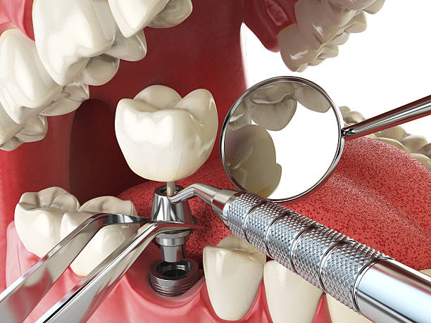 Best Emergency Root Canal Treatment in Astia, OR